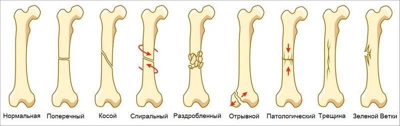 Перелом первого января thumbnail