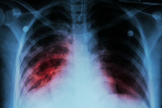 Туберкулёз:  Болезнь, о которой  не говорят